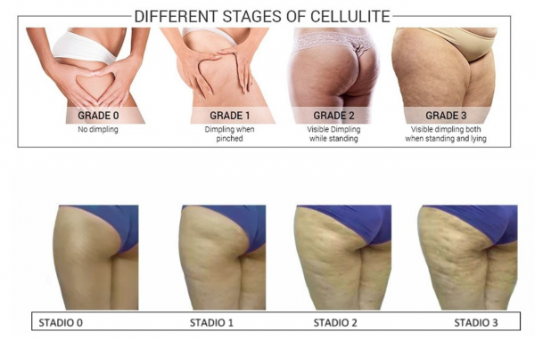 fasi-cellulite-diversamente-benessere
